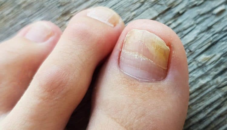 Peut-on traiter une mycose de l’ongle au laser | All Aesthetics