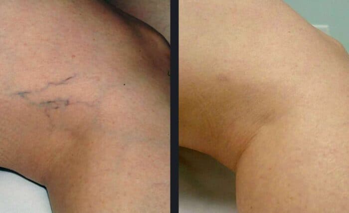 prestation Laser vasculaire Cannes