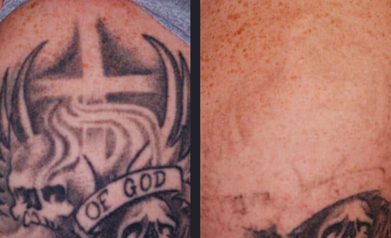 Détatouage laser picoseconde noir-avant après-Centre bien être et médecine esthétique Cannes -All Aesthetics