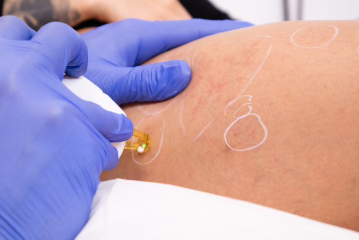 Prestation Laser vasculaire, traitement des vaisseaux Cannes