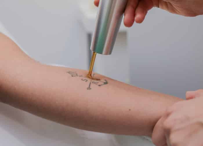 prestation Détatouage laser Picoseconde Cannes
