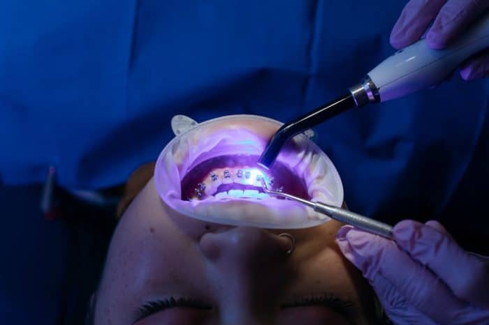 Blanchiment dentaire : comment fonctionne le traitement ?
