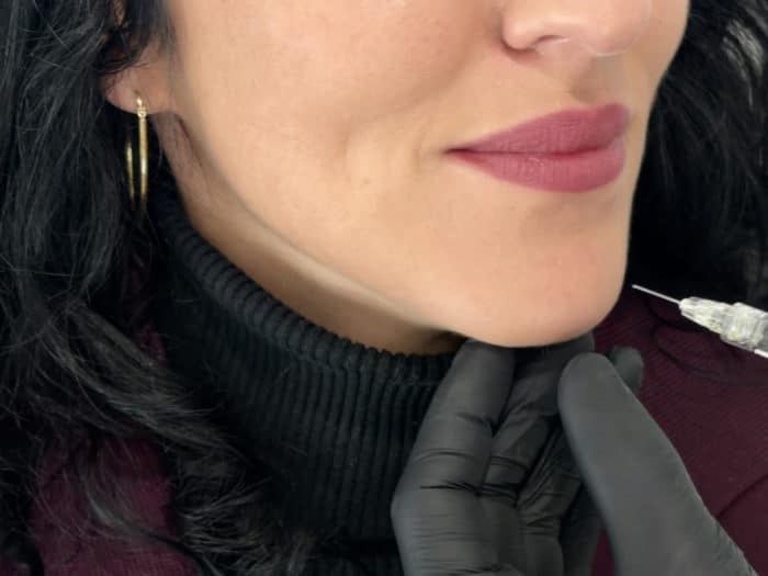 prestation Injections menton acide hyaluronique Cannes