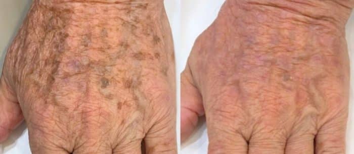 prestation Laser pigmentaire Cannes