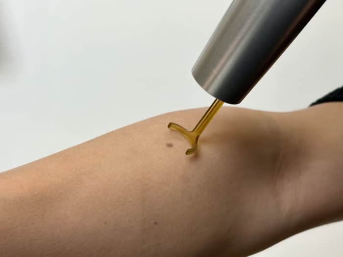 prestation Laser pigmentaire nævus Cannes