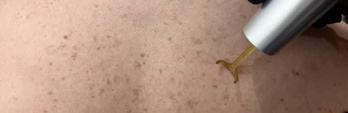 prestation Laser pigmentaire taches de rousseur Cannes