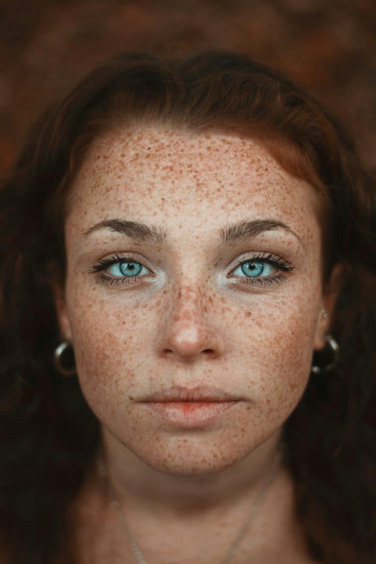 Laser pigmentaire taches de rousseur Cannes- Traitement de la peau-Centre médecine esthétique-All Aesthetics -1