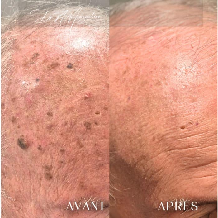 prestation Laser pigmentaire kératose séborrhéique Cannes