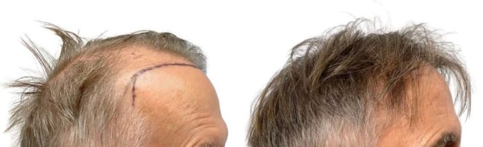 prestation Greffe de cheveux Cannes