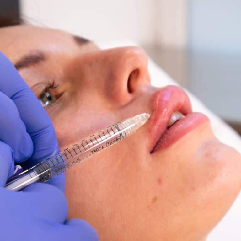 Centre Médecine esthétique-injection acide hyaluronique levres supérieures-all aesthetics Cannes-2