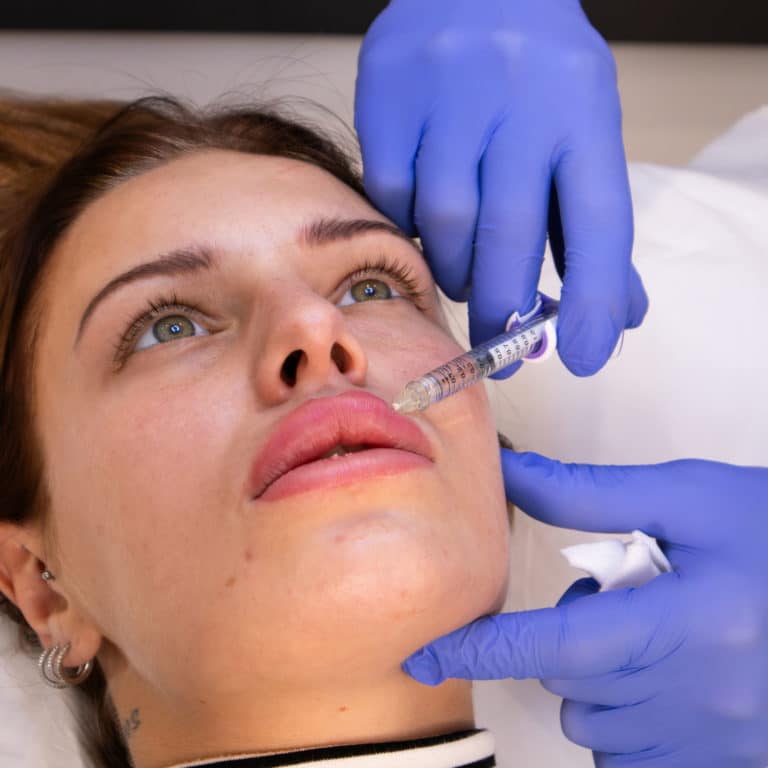 Centre Médecine esthétique-injection acide hyaluronique levres supérieures-all aesthetics Cannes-3